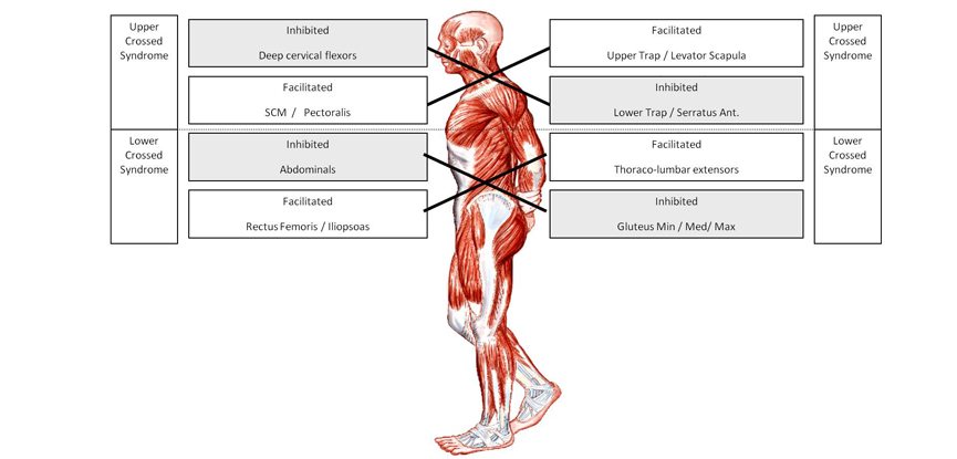 Upper cross and lower cross syndrome