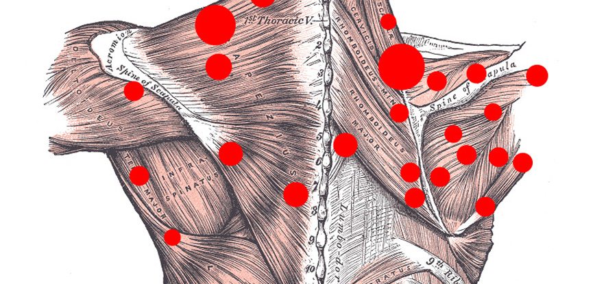 A look at the myofascial trigger points in the body