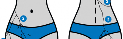An illustration of thoracolumbar junction syndrome or magine's syndrome