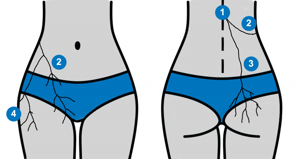 Pattern of left flank pain from the thoracolumbar junction syndrome.