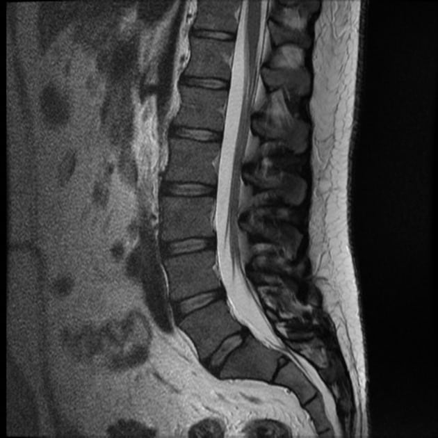 An MRI image of a spine