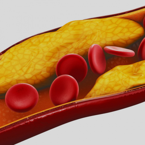 An image of an artery depicting the condition of atherosclerosis