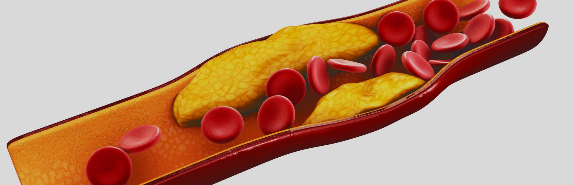 An image of an artery depicting the condition of atherosclerosis