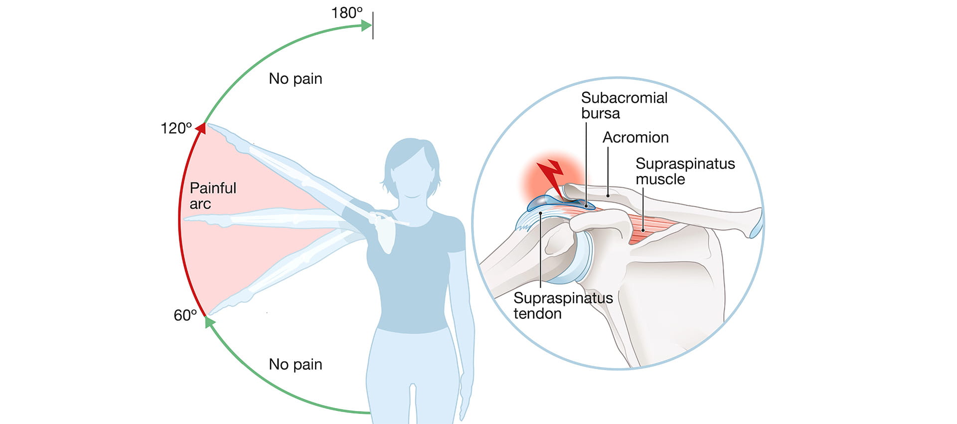 shoulder impingement